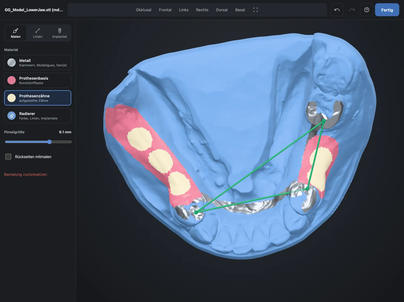 Lower model scan painted with clasps, lingual bar, denture base and teeth