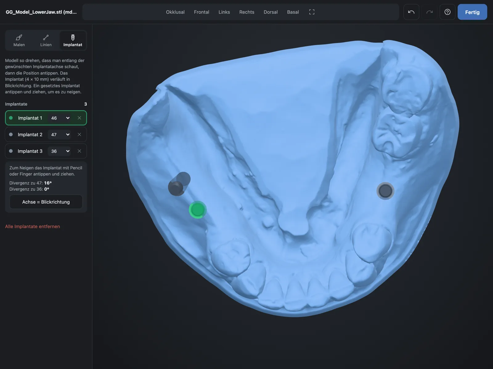 Three implants placed on the lower model scan, one of them selected
