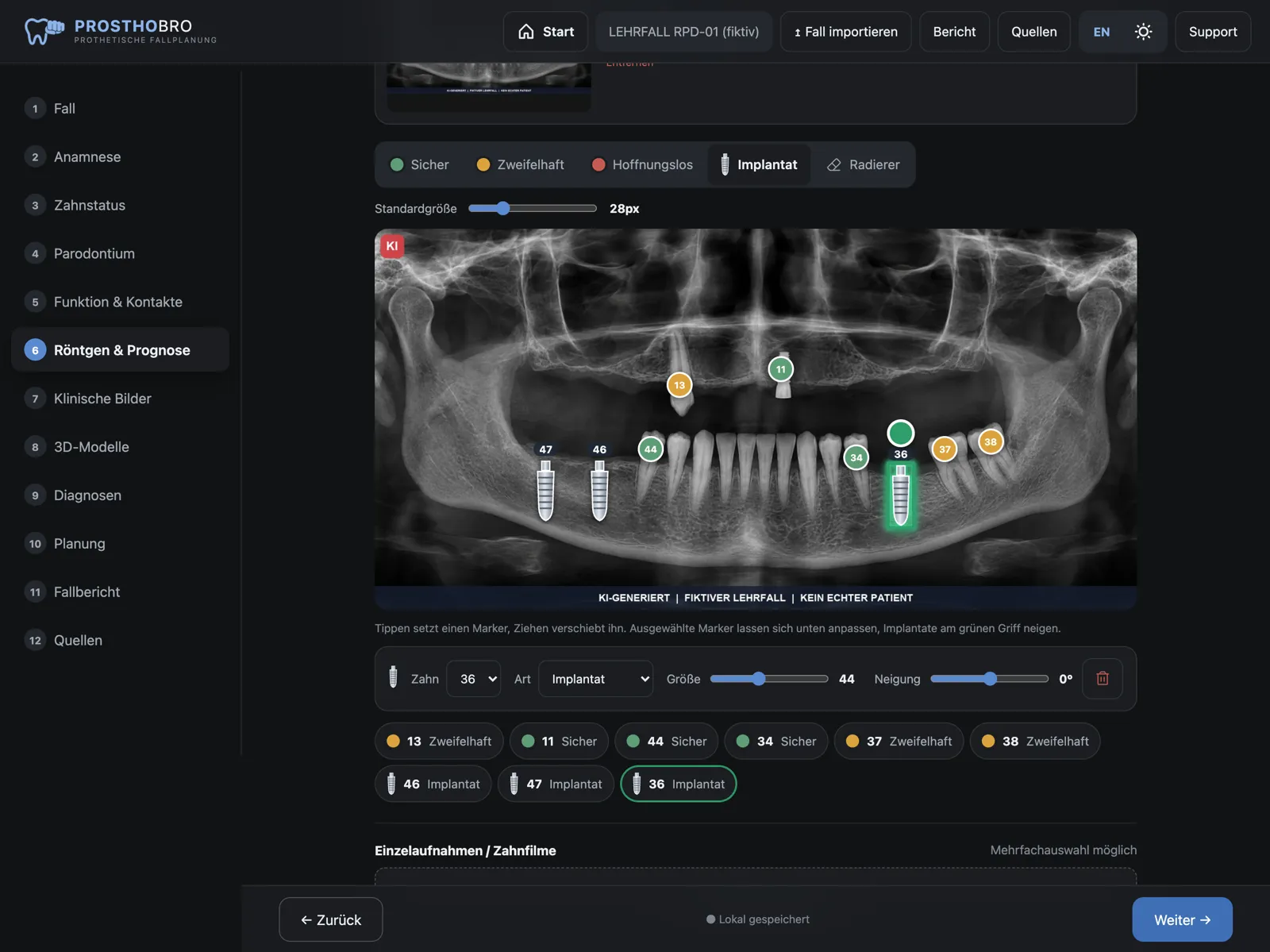 Panoramic X-ray of the fictional case with tooth prognosis and implants marked